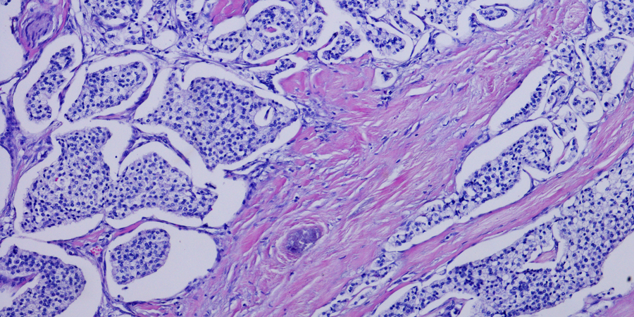 Pancreatic cancer phd thesis